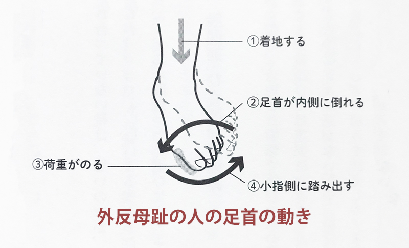 必見 外反母趾の本当の原因とは 南青山 足から治療院 クレアーレ